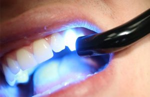 Lee más sobre el artículo ¿6 maneras de garantizar la durabilidad de la lámpara de luz led de fotocurado?