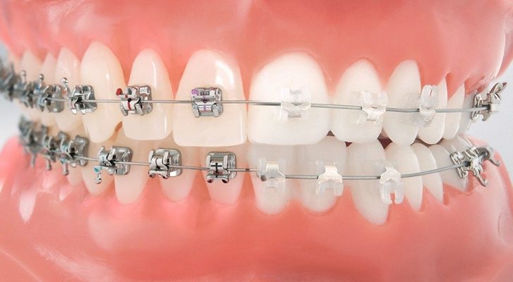 Lee más sobre el artículo ¿Cómo elegir los Brackets Ideales, según la necesidad de tu paciente?