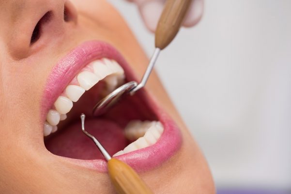 Lee más sobre el artículo ¿Cuánto tiempo dura una resina dental?