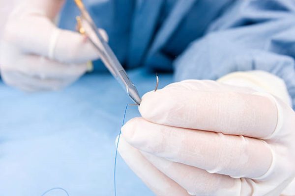 Lee más sobre el artículo Suturas en odontología: Características y criterios para la selección