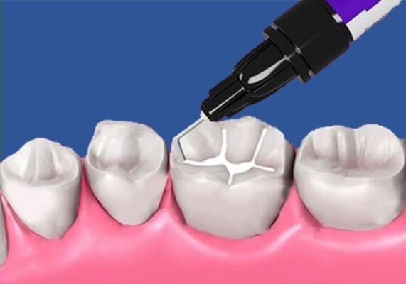 Lee más sobre el artículo Qué es un sellador dental y cuándo se aplica