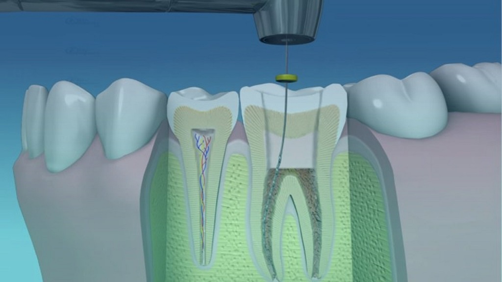 Lee más sobre el artículo La endodoncia de hoy revoluciona con su técnica mecanizada
