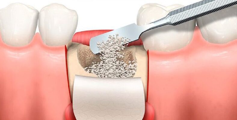 Lee más sobre el artículo Regeneración ósea: Tipos de injerto para procedimiento quirúrgicos dentales